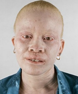 human albinism